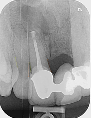 Dental X-ray showing a treated tooth