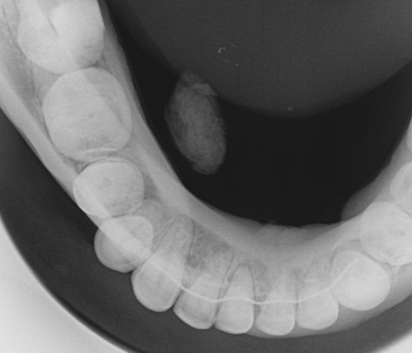 Removal-of-salivary-stone